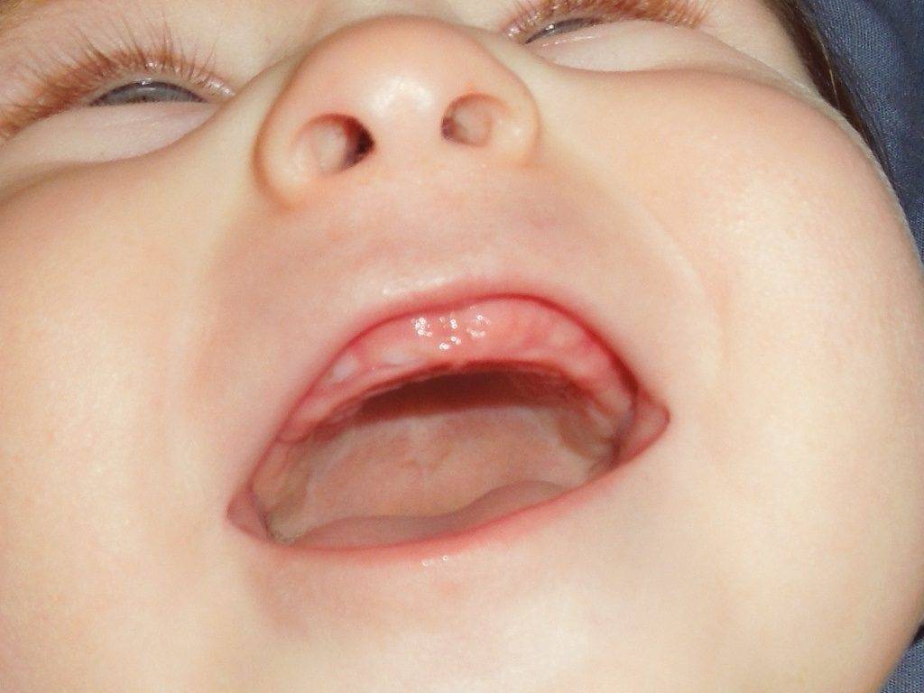 Общие и тревожные симптомы прорезывания зубов у детей после года