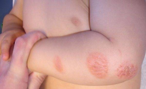 Сыпь под коленом - запись пользователя марина (id984609) в сообществе детские болезни от года до трех в категории высыпания на коже - babyblog.ru