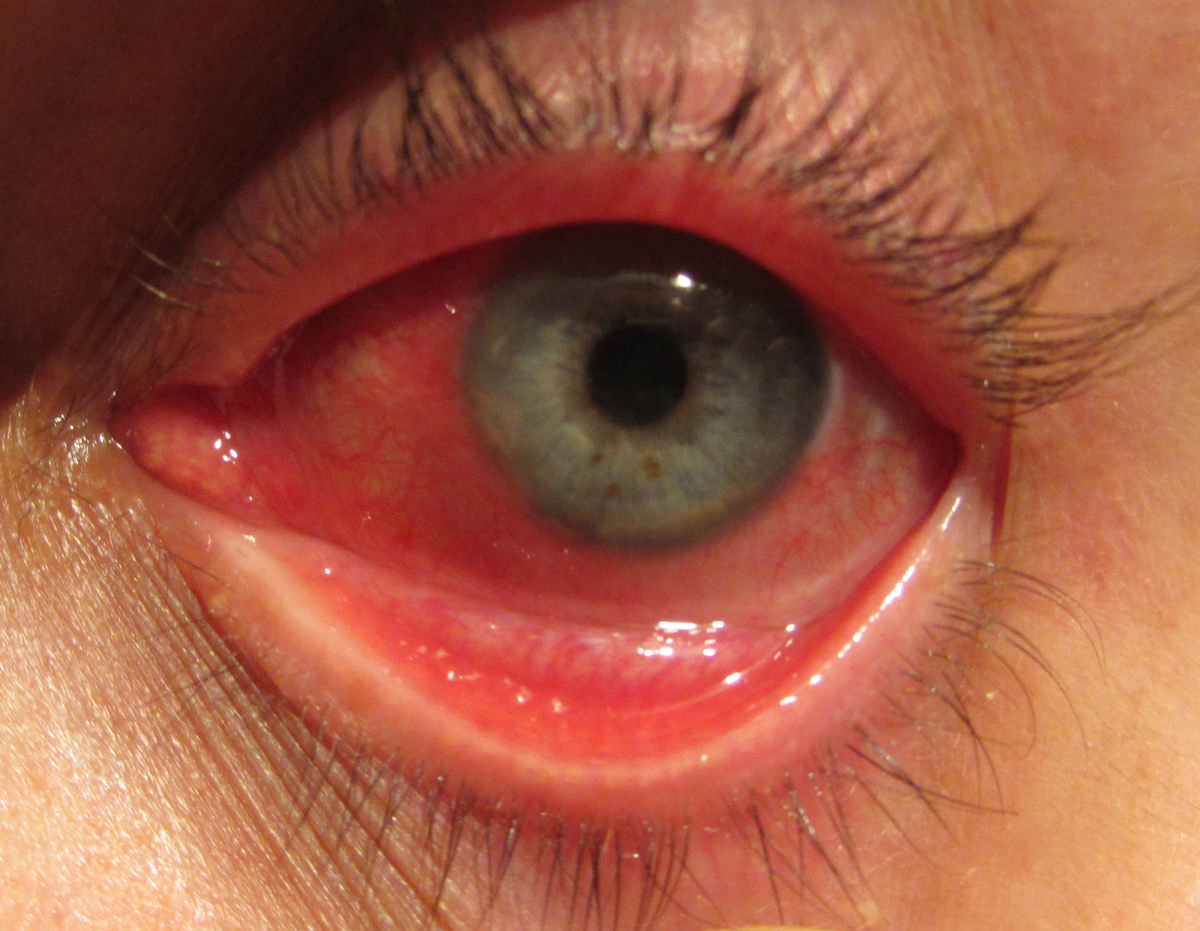 Что делать при обнаружении ангиопатии сетчатки глаза у детей?