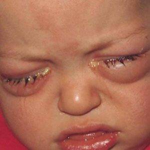 Чем промыть глаза грудному ребенку. чем протирать новорожденным глазки, и как правильно это делать