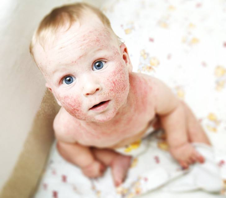 Что делать с высыпаниями на коже у ребенка в виде крапивницы? фото сыпи на теле с пояснениями