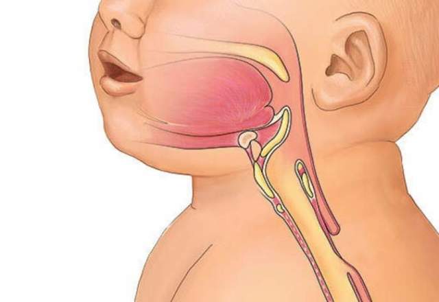 Пилоропластика у новорожденного. трахеопищеводный свищ и атрезия пищевода у новорожденного