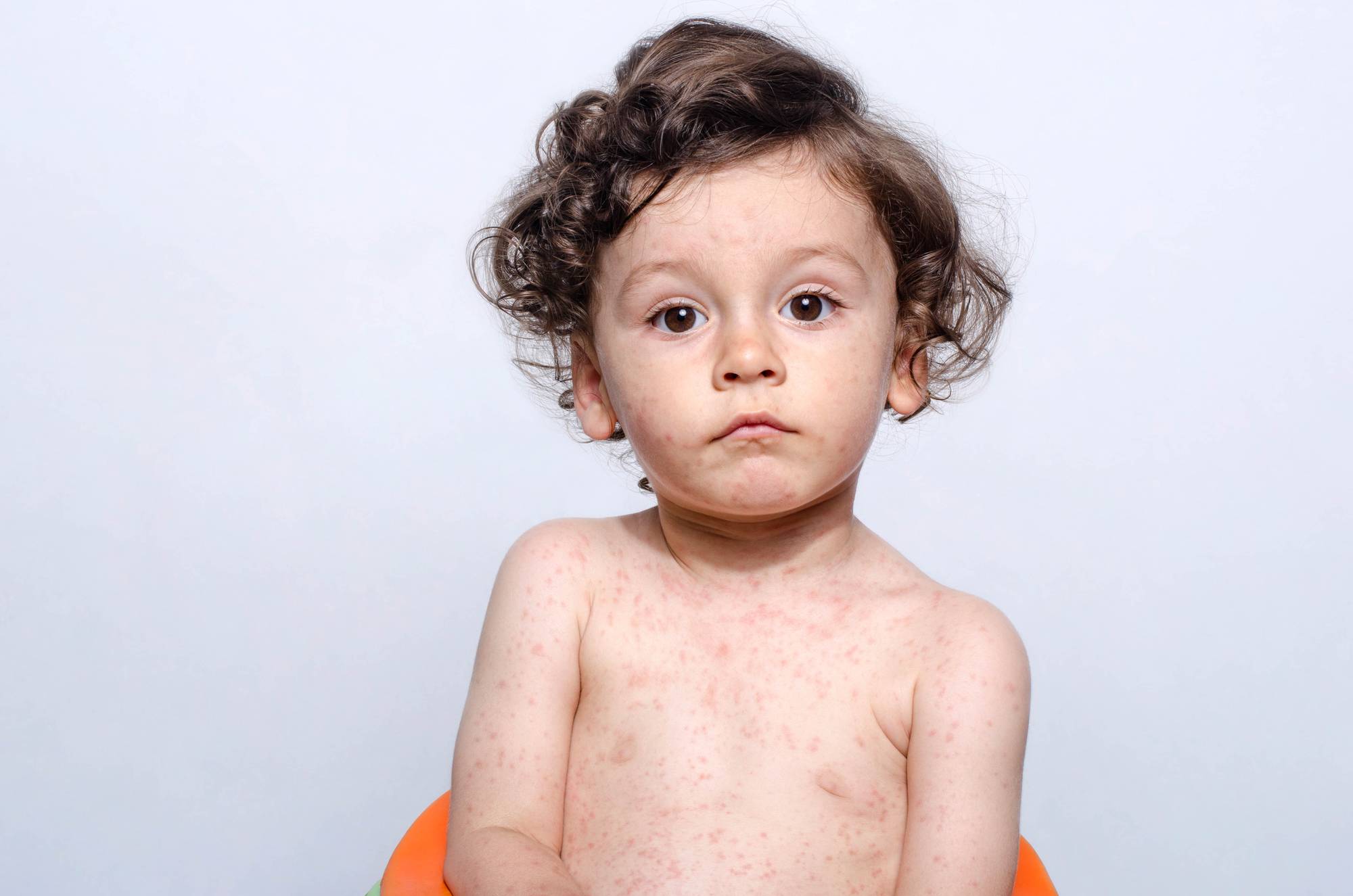 Температура и сыпь у ребенка: после высокой температуры по всему телу, в горле и рту