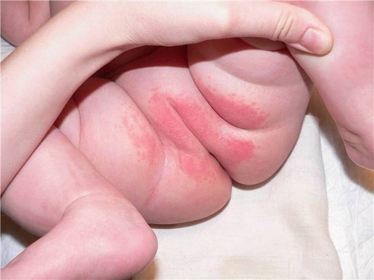 Красная попка - у грудничка красная попа - запись пользователя катюша (89220539181) в сообществе здоровье новорожденных в категории аллергия - babyblog.ru