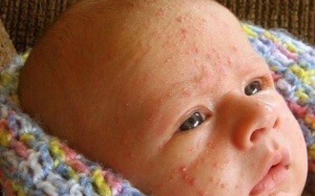 Аллергия у ребенка. причины, симптомы, лечение и профилактика аллергии