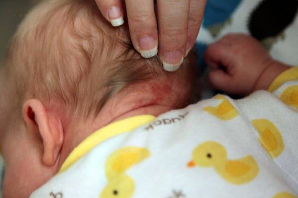 Красные пятна на лице и шее у новорожденного: что это?