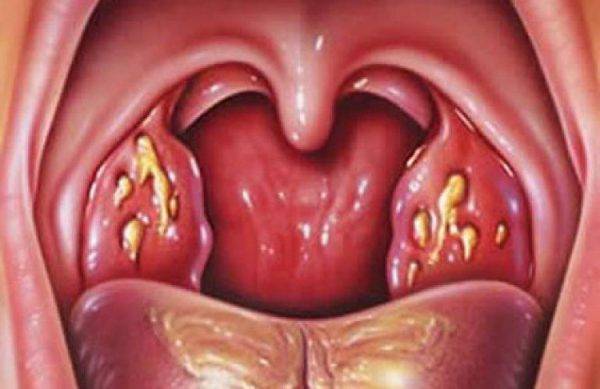 Фото как выглядит больное горло у ребенка