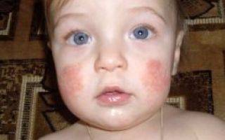 Сыпь у новорожденных на лице с желтой корочкой