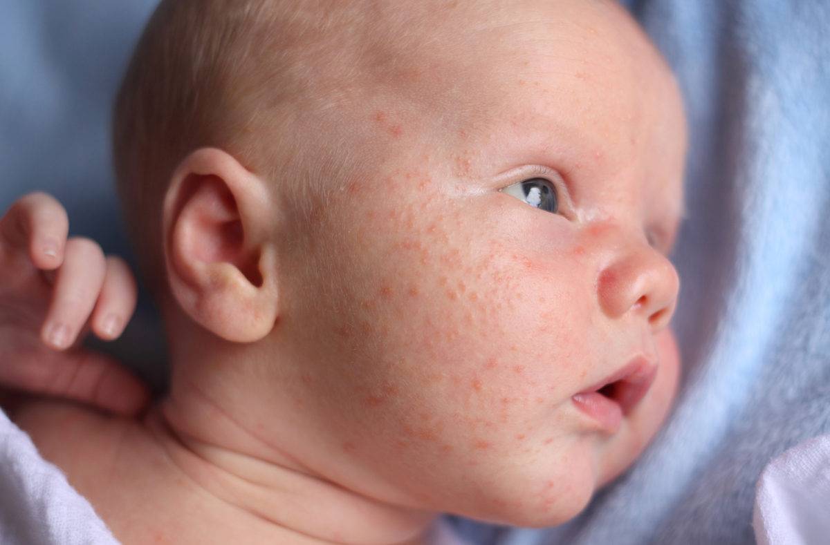 Сыпь на животе у ребенка (29 фото): причины с пояснениями, мелкая и красная, после высокой температуры