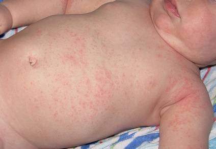 Аллергия или потничка? - запись пользователя леся (mavrika2) в сообществе здоровье новорожденных в категории кожные заболевания - babyblog.ru