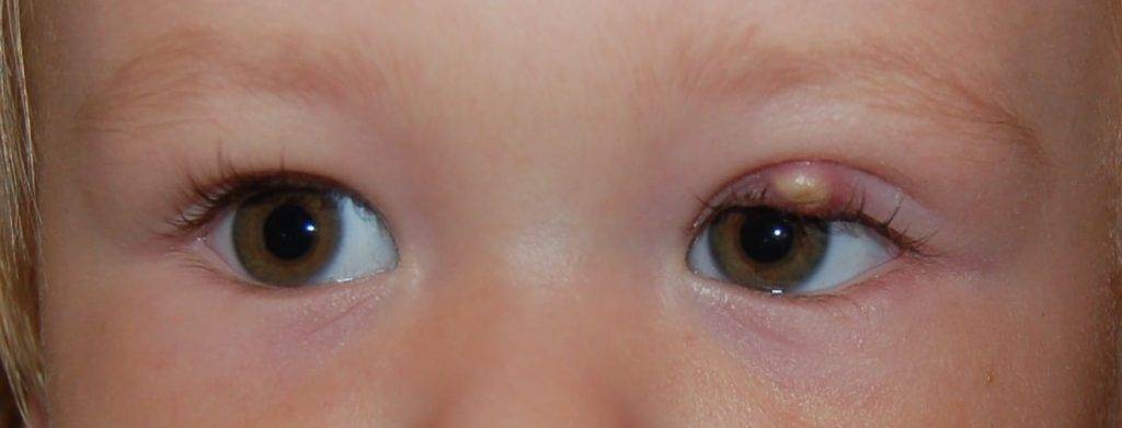 Мешки под глазами - у ребенка мешки под глазами комаровский - запись пользователя natashula (natashula) в сообществе детские болезни от года до трех в категории лечение воспаления мочевыводящих путей, работе почек, пописах и их количестве. - babyblog.ru