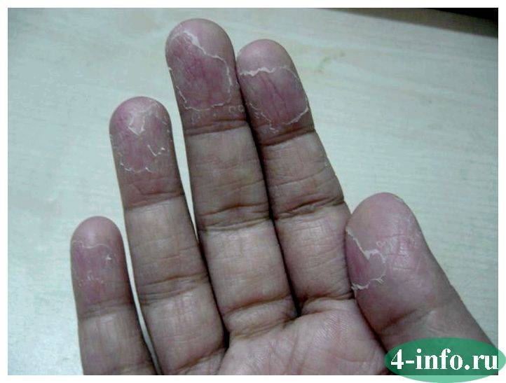 Если у ребенка облезает кожа на пальцах... - облазит кожа на пальцах рук у ребенка - запись пользователя алекс (lu0001) в сообществе детские болезни от года до трех в категории пальчики и ноготочки - babyblog.ru