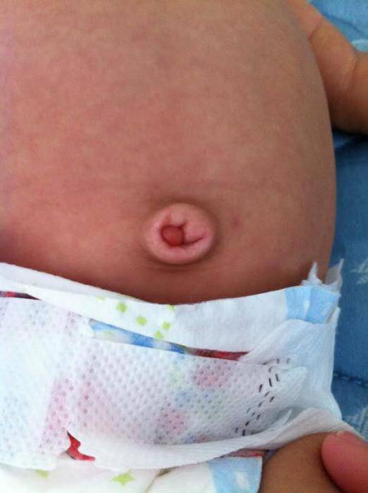 Пупочная грыжа у новорожденных (53 фото): как выглядит, симптомы и лечение у грудничков-мальчиков, массаж