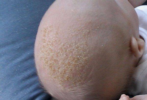 Почему шелушится кожа у новорождённого на голове, лице и теле