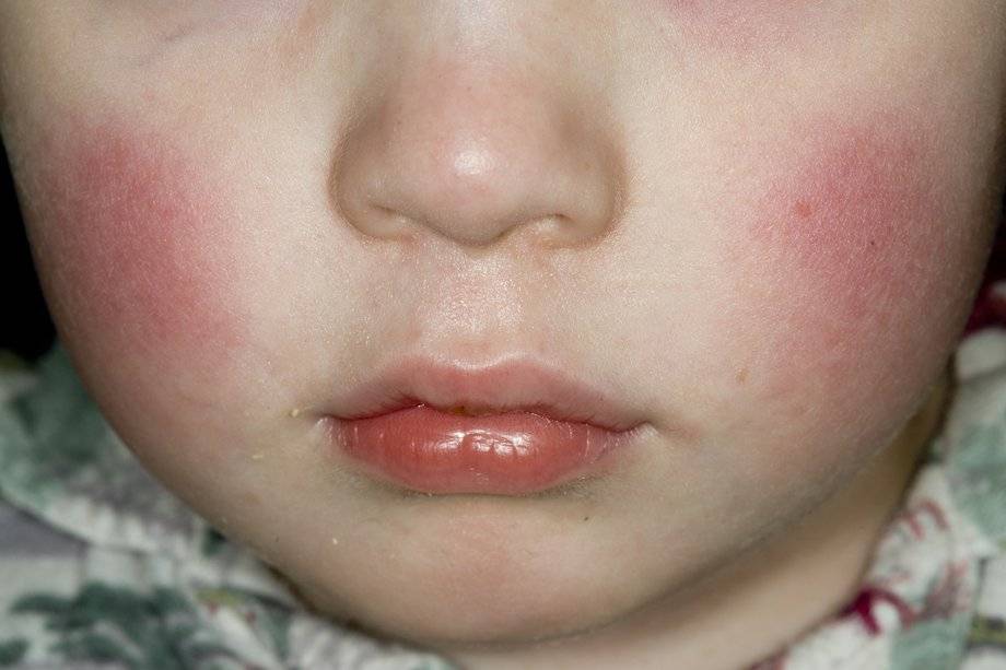 Температура и сыпь у ребенка: причины и возможные болезни
