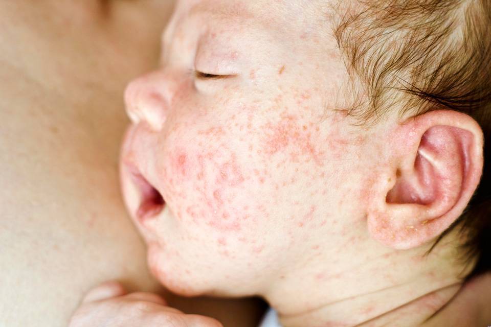 Пищевая аллергия у грудничка. аллергическая реакция у ребенка
