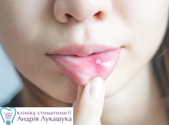 Почему появляются язвочки во рту у ребенка младше года