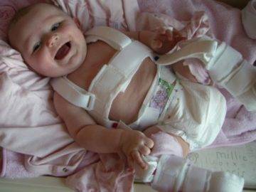 Полный обзор дисплазии тазобедренных суставов у новорожденных и грудничков