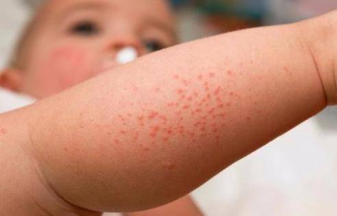 Аллергия у детей — виды, симптомы, лечение