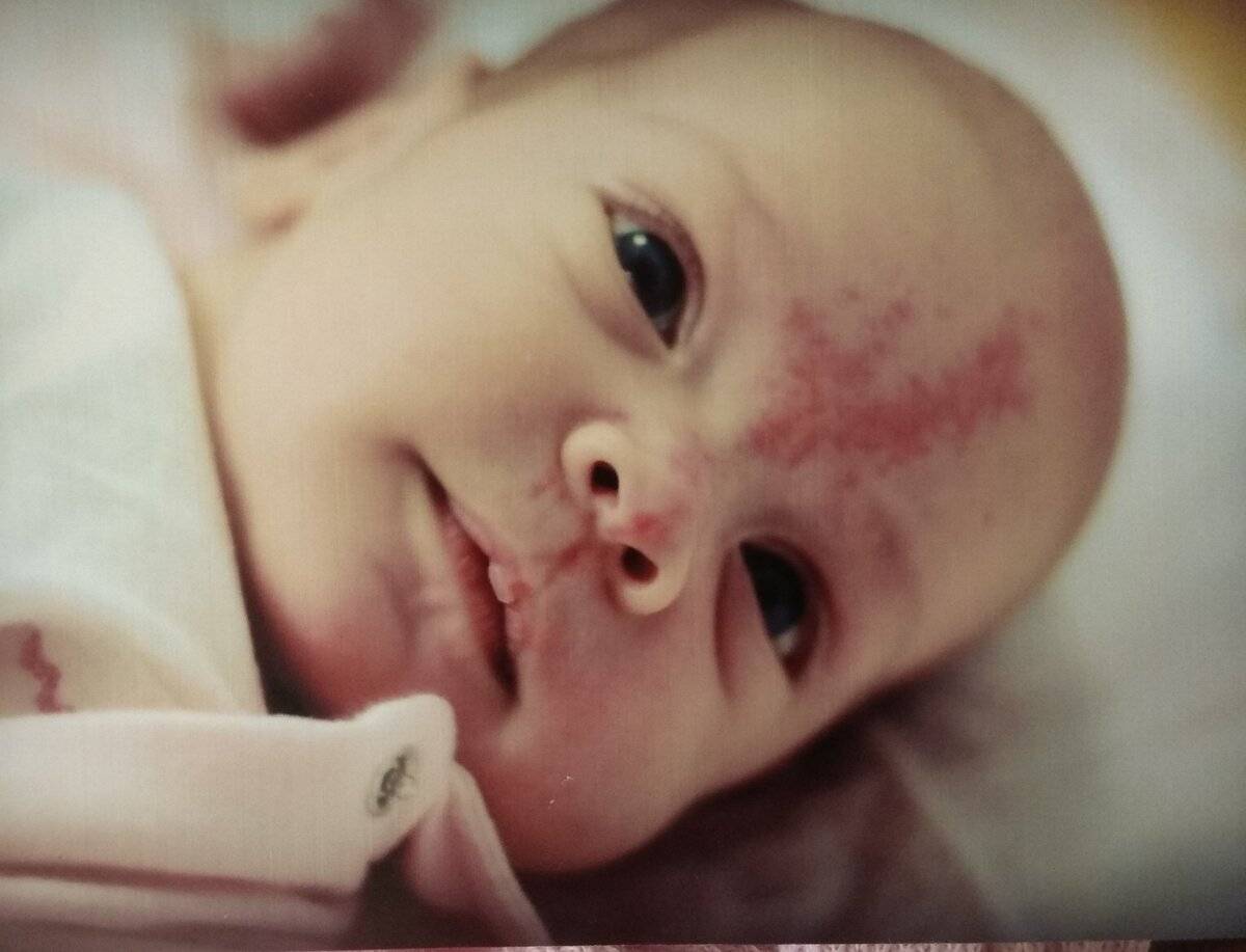 Красные пятна на лице у новорожденного: высыпания на коже головы