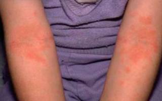 Сыпь и пятна на локтях (аллергия) у взрослых и детей: что это, фото с пояснениями