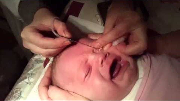 Как правильно делать массаж для открытия слезного канала у новорожденных