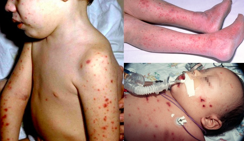 Аллергическая сыпь у детей фото и описание