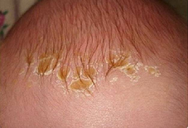 Причины сухости и шелушения кожи у грудного ребенка - лечение мазями, кремами и народными средствами