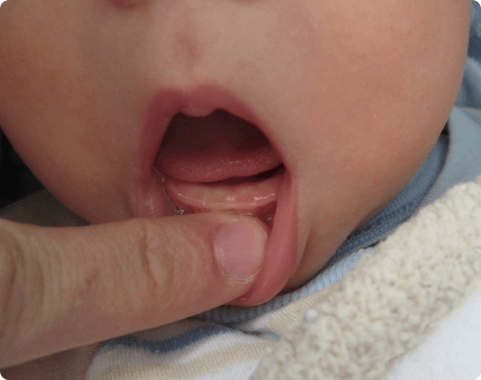 Как понять, что кашель и насморк у ребенка из-за прорезывания зубов