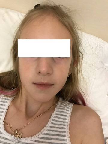 Перелом носа у ребенка: симптомы, признаки, лечение