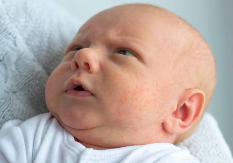 Аллергия у грудничка на лице: особенности проявления
