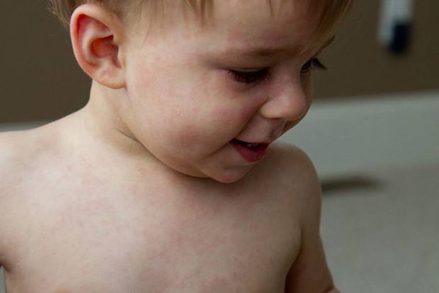 Е. комаровский: розеола (11 фото): симптомы и лечение детской болезни