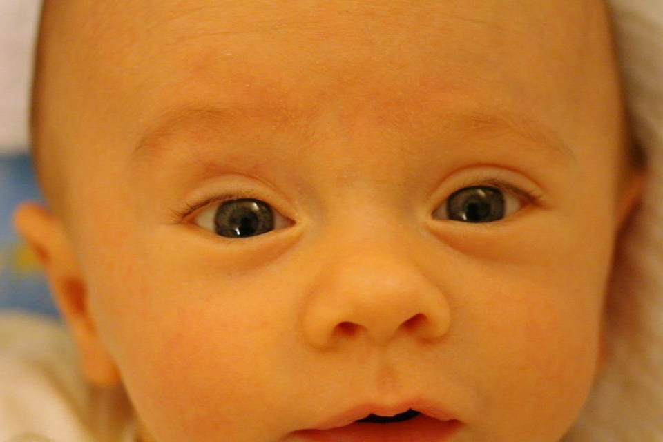 У ребенка желтые глазные яблоки. жёлтые белки глаз причины и лечение