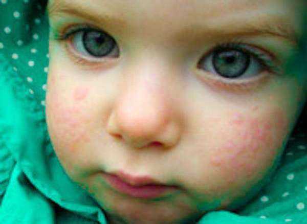 Бывает ли аллергия на грудное молоко у ребенка при грудном вскармливании