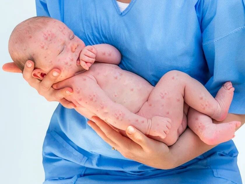 Сыпь у новорожденного, грудничка и месячного ребенка: причины красных высыпаний с пояснениями, красная и мелкая сыпь теле, голове и щеках