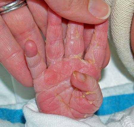 Причины шелушения кожи на ладонях у детей и взрослых - что делать и средства лечения