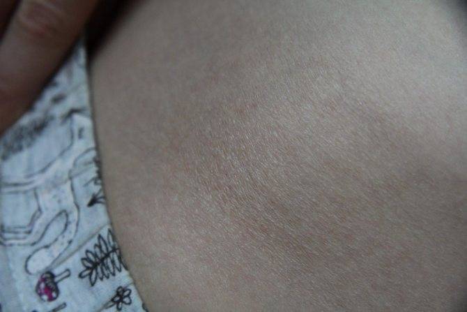 Шершавая кожа у грудничка - запись пользователя катя (iamkatarina) в сообществе здоровье новорожденных в категории кожные заболевания - babyblog.ru