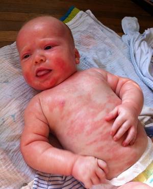 Симптомы аллергии на коровий белок у ребенка: подробный обзор