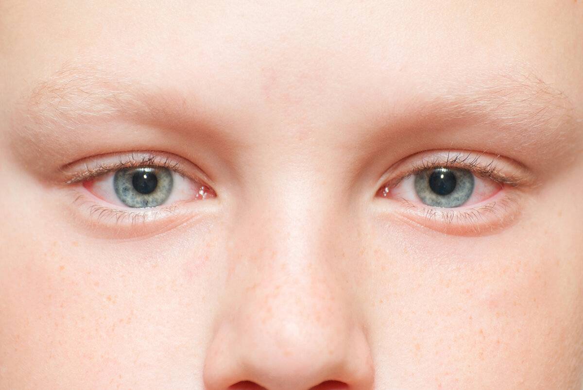 О чем говорят отеки и мешки под глазами у детей?