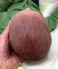У нас маленькая голова! - маленькая голова - запись пользователя зоя (id782857) в сообществе здоровье новорожденных в категории неврология - babyblog.ru