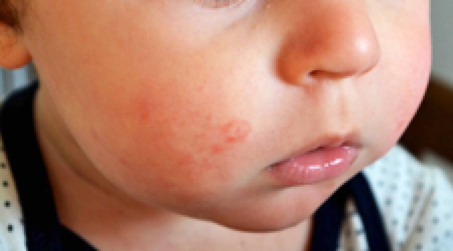 Язвочки на теле у ребенка — почему мокнут, не заживают болячки