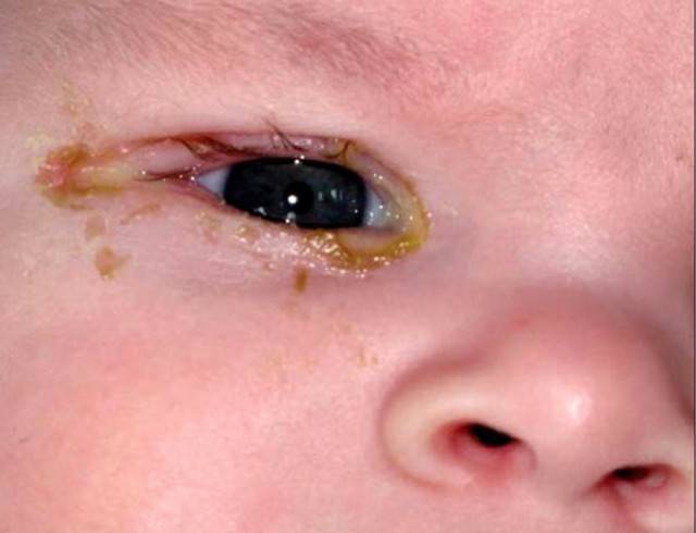 Как закапать капли в глаза ребенку без нервов и слез?