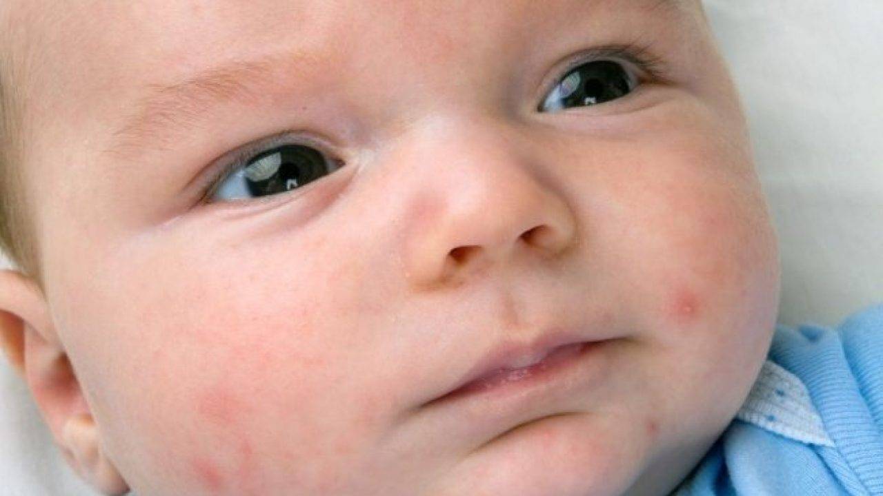 Жировики на лице у новорожденного: лечить или нет?