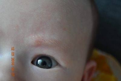 Е. комаровский: сухая кожа у ребенка - причины у младенца,сухость кожи щек и ног у малыша