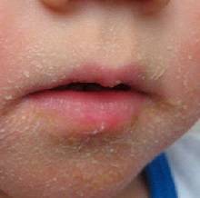 Что делать, если появилась сыпь во рту у ребенка?