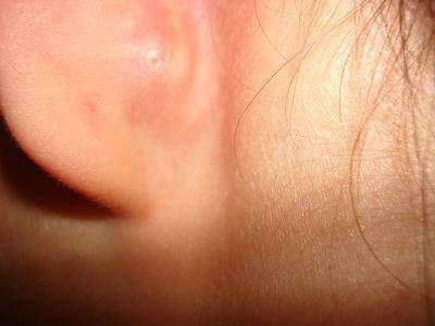 У ребенка за ухом шишка, нарост в форме шишки: что это такое (фото)
