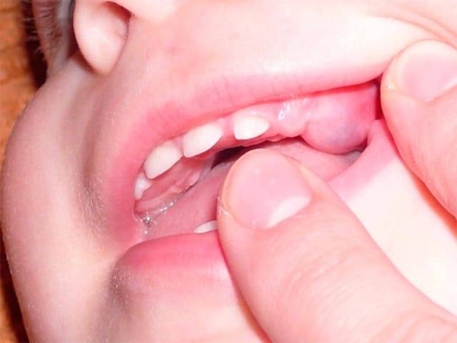 Как понять что у ребенка режутся зубы в 4 месяца