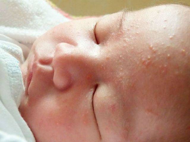 Жировики у новорожденных: причины и лечение