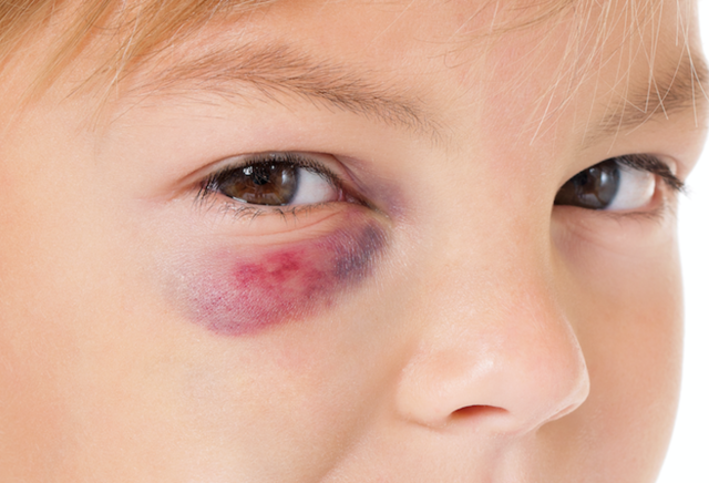 Почему у ребенка бывают синяки под глазами и какое лечение требуется