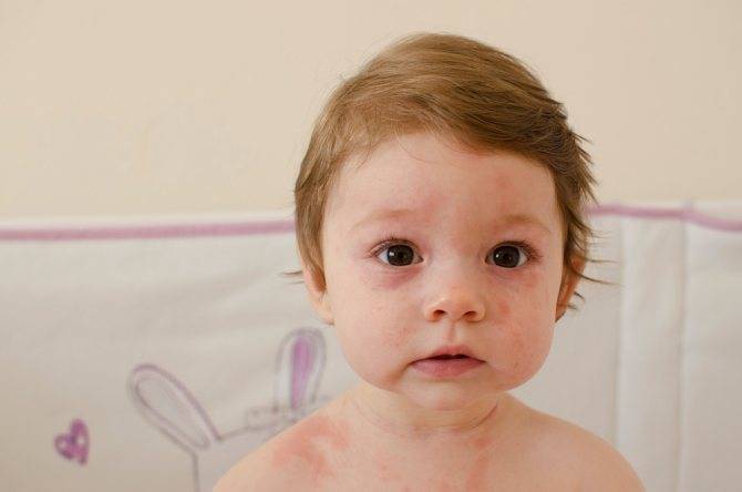 Розеола - розеола у детей симптомы фото - запись пользователя марта быстрова (marthaschander) в дневнике - babyblog.ru